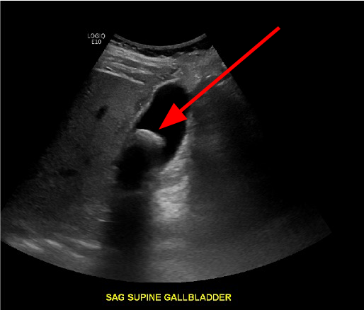 Ultrasound image of gallstone